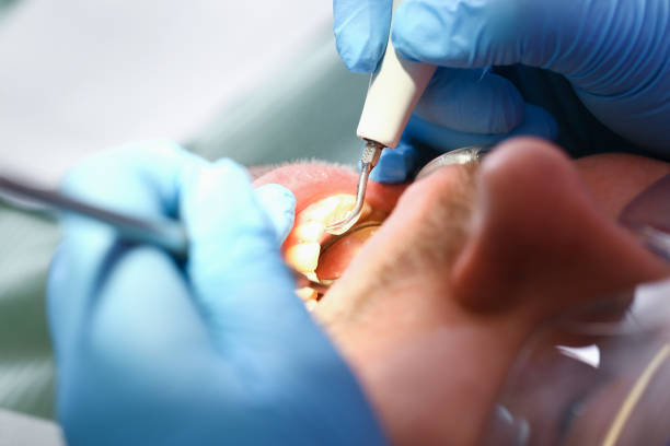 Best Chipped Tooth Repair Near Me  in Butler, AL